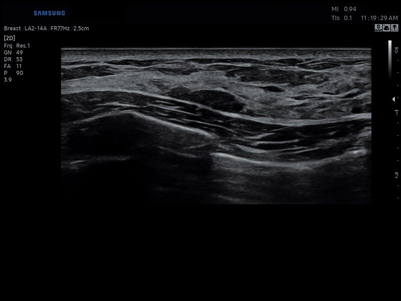 Breast, B-mode (echogramm №803)