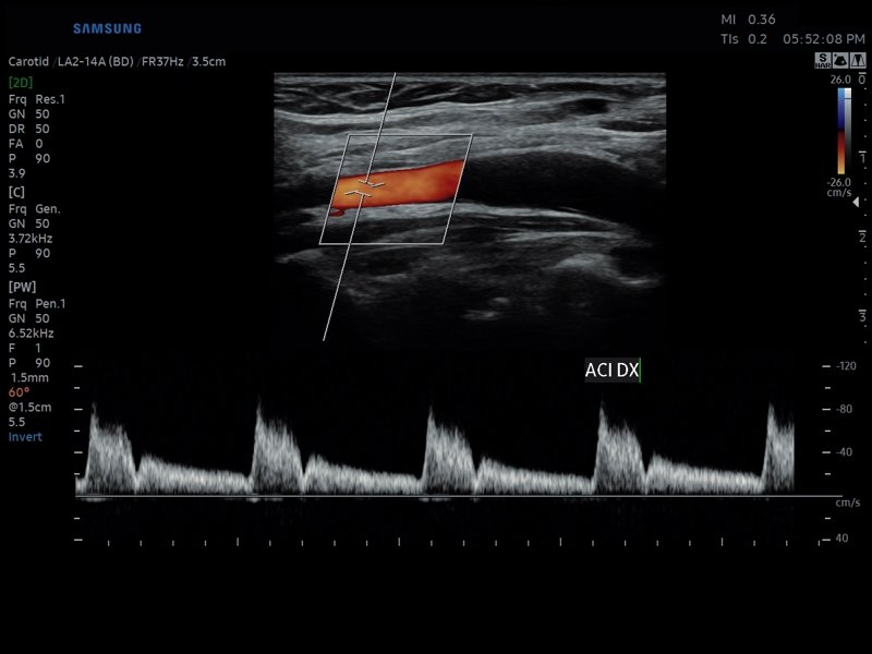 Internal carotid artery, CFM & PW (echogramm №804)