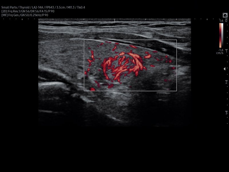 Thyroid nodule, MV-Flow (echogramm №805)