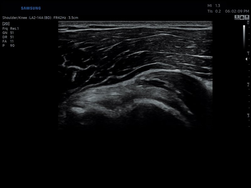 Shoulder, B-mode (echogramm №806)