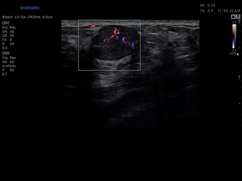 Breast, color doppler (echogramm №809)