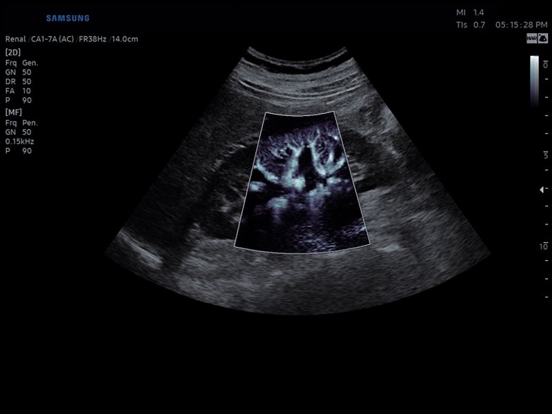 Kidney, MV-Flow (echogramm №810)