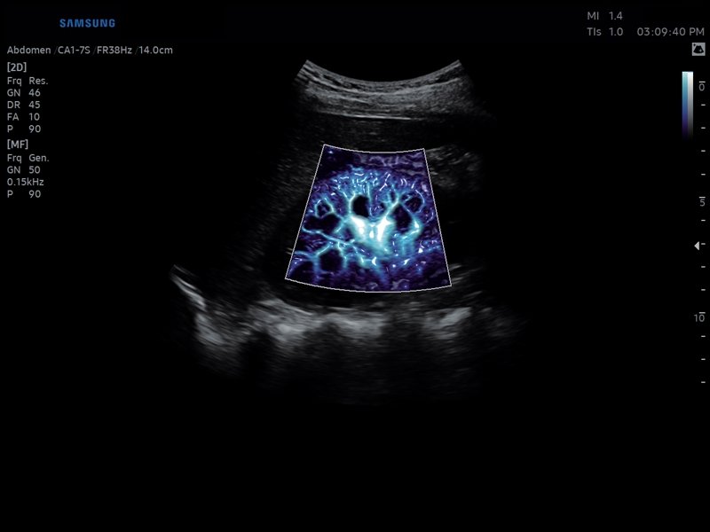 Kidney, MV-Flow + LumiFlow (echogramm №813)