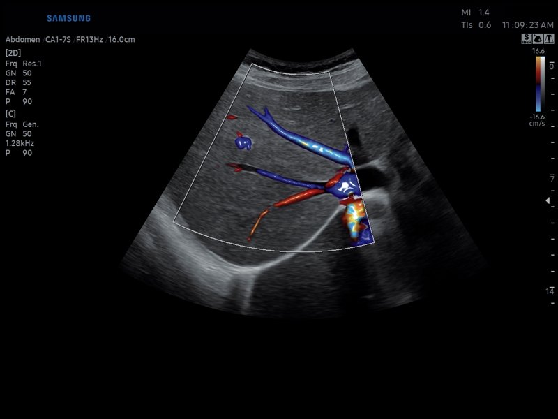 Liver, MV-Flow + LumiFlow (echogramm №814)