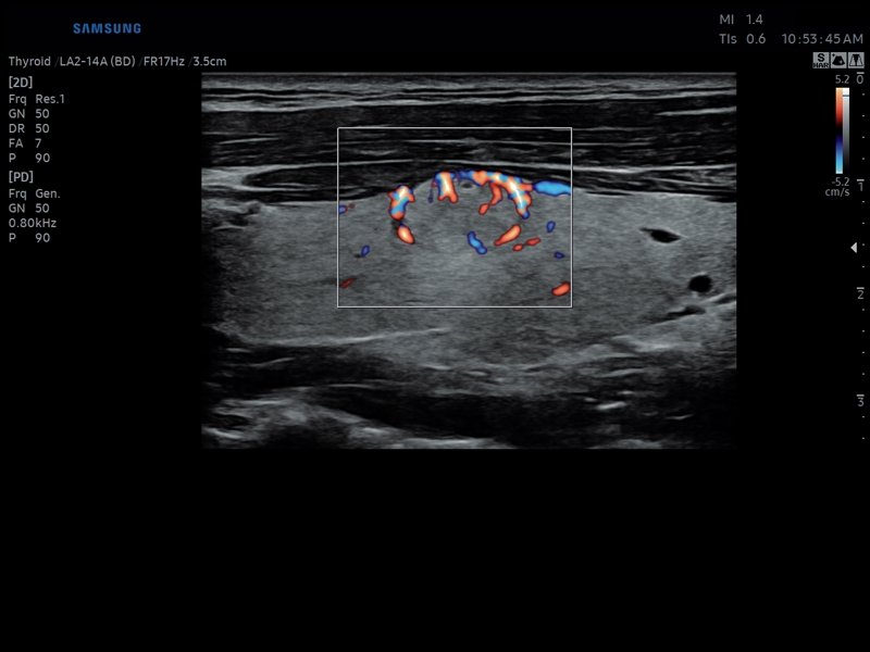 Thyroid, S-Flow (echogramm №815)