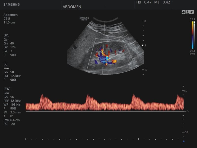 Kidney, CFM & PW (echogramm №819)