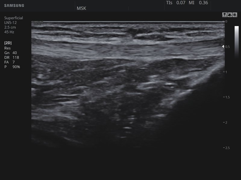 Knee, ClearVision (echogramm №820)