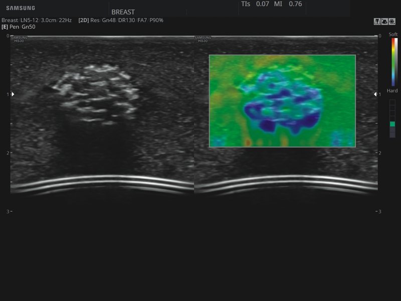 Breast (phantom), Elastoscan (echogramm №821)