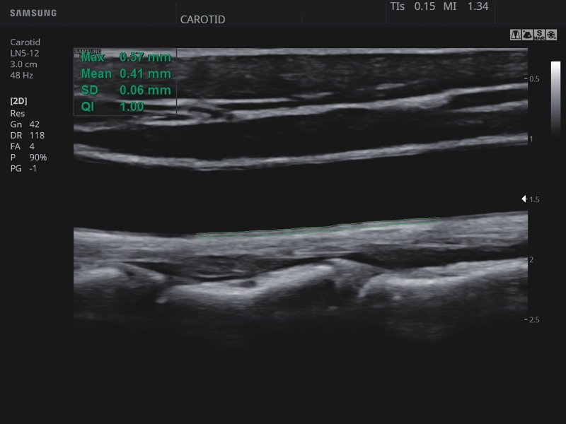 Common carotid artery, AutoIMT+ (echogramm №822)