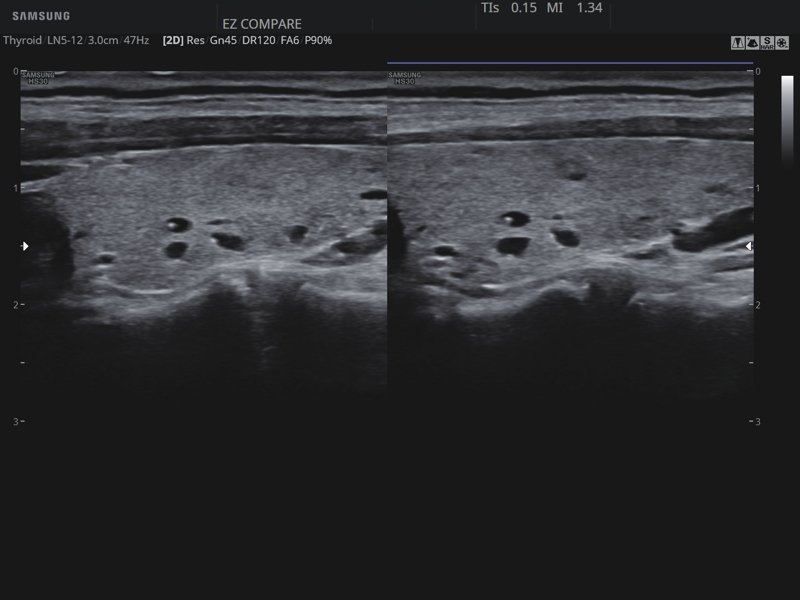 Thyroid, EzCompare (echogramm №824)