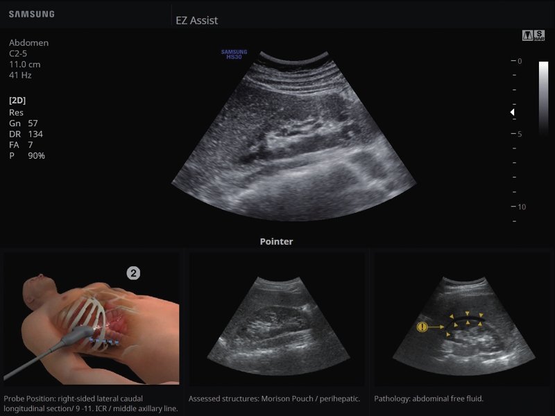 Kidney, EzAssist (echogramm №825)