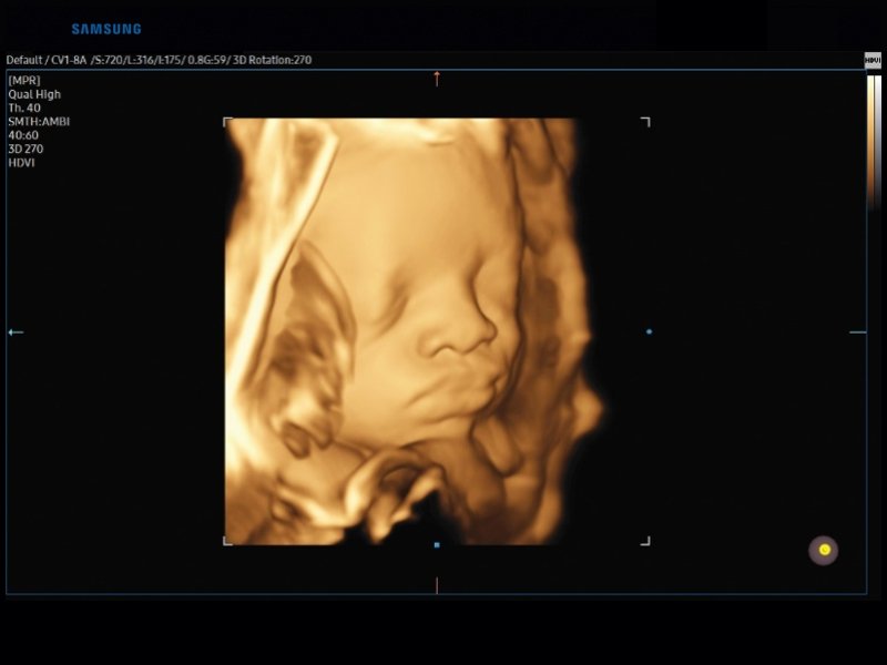 Fetal face, 3D (echogramm №826)