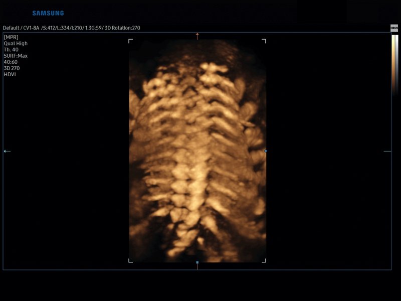 Fetal spine, 3D (echogramm №827)