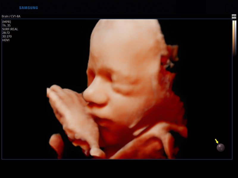 Fetal face, Realistic Vue, 3D (echogramm №828)