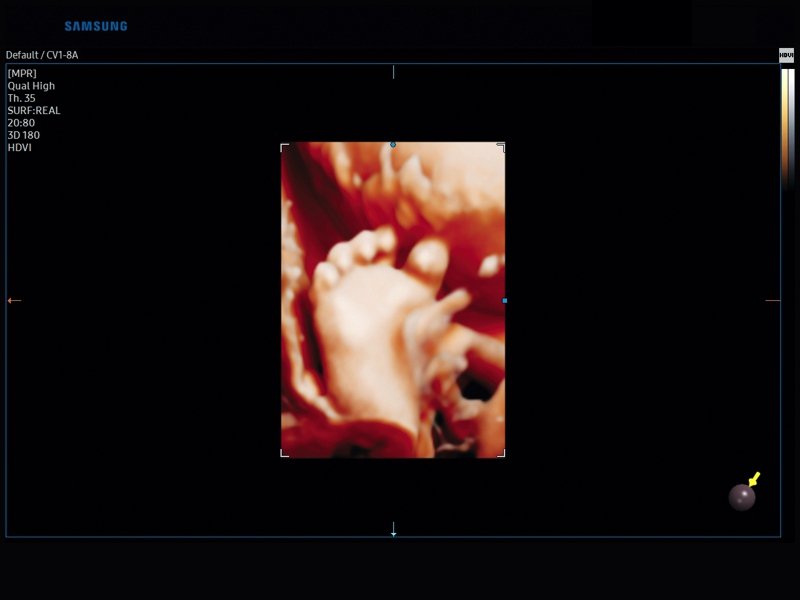 Fetal foot, Realistic Vue, 3D (echogramm №829)