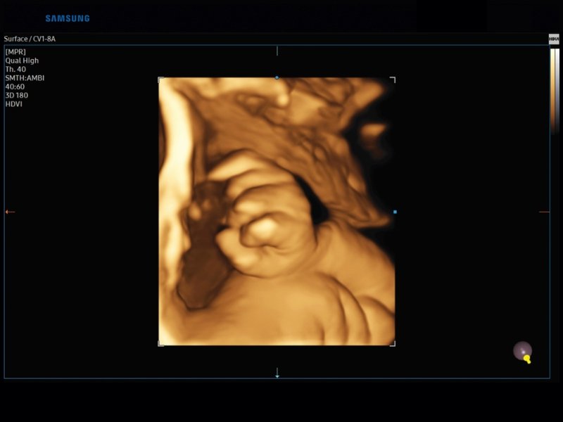 Fetal hand, 3D (echogramm №830)