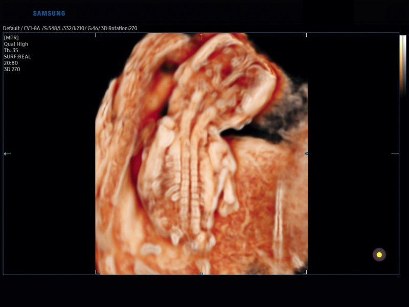 Fetal spine, CrystalVue, 3D (echogramm №831)