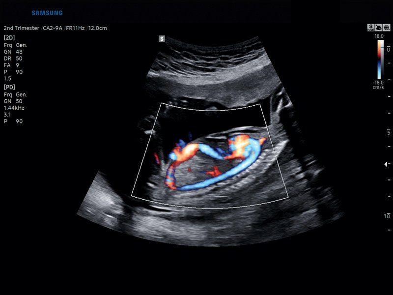 Fetal blood flow, S-Flow (echogramm №832)