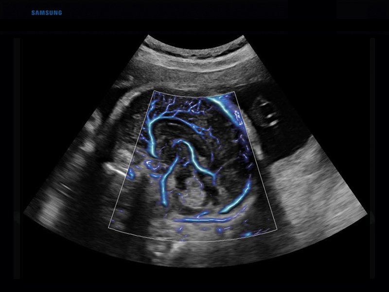 Fetal brain, MV-Flow (echogramm №833)