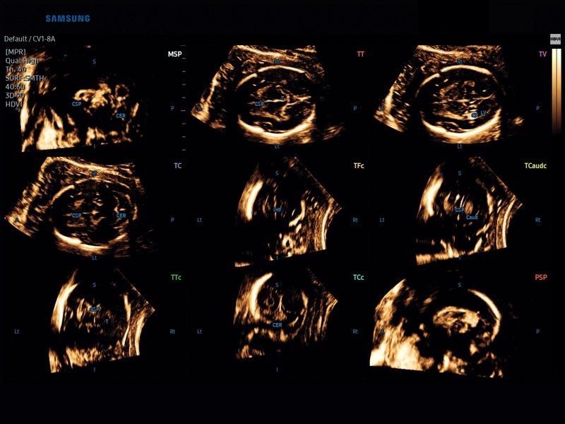 Fetal brain, 5D CNS+ (echogramm №836)
