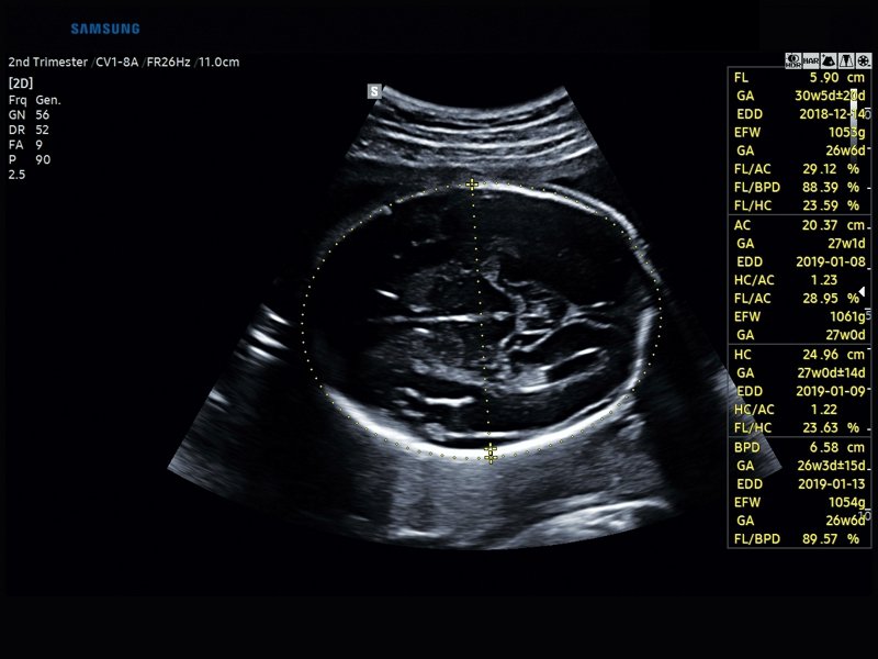 Fetus, BiometryAssist (echogramm №837)