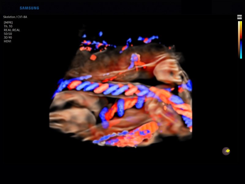 Umbilical cord, color doppler + S-Flow (echogramm №838)