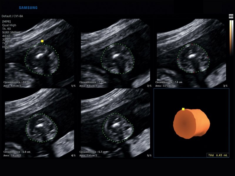 Fetus, 5D Limb Vol (echogramm №839)