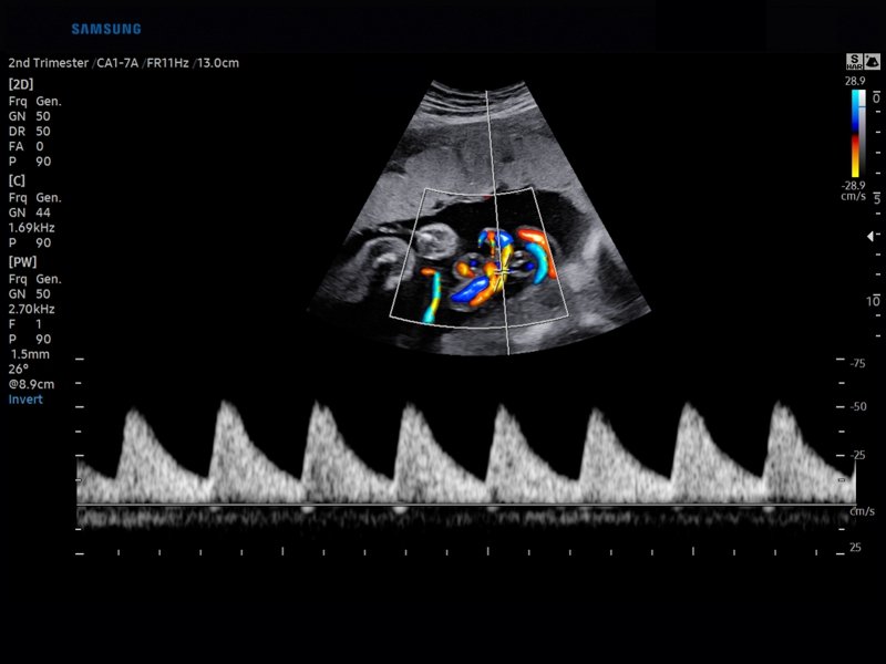 Umbilical cord, CFM & PW (echogramm №840)