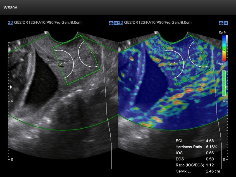 Cervix, elastogaphy (echogramm №841)