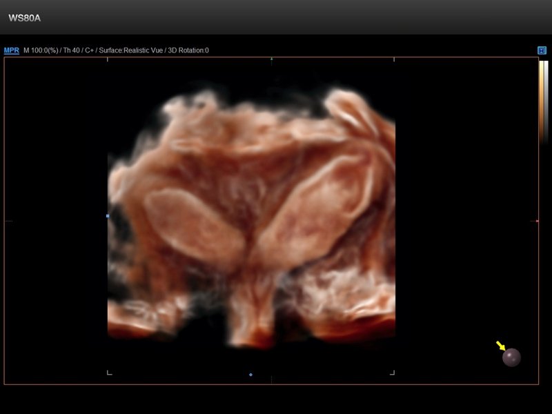 Bicornuate uterus, Crystal Vue, 3D (echogramm №842)