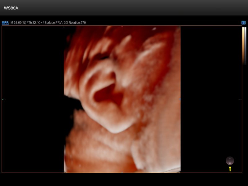 Fetal ear, Realistic Vue, 3D (echogramm №843)