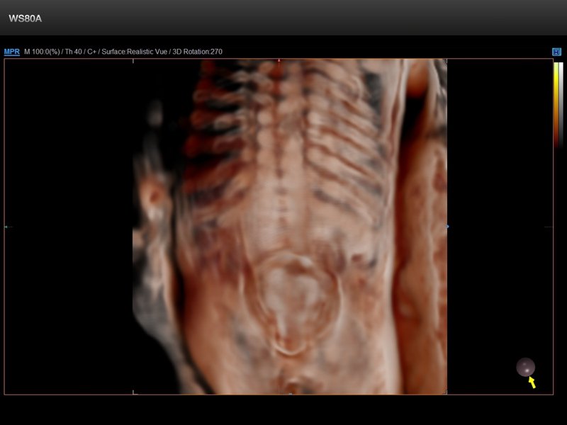 Spina bifida - defect of fetal`s development, 3D (echogramm №844)