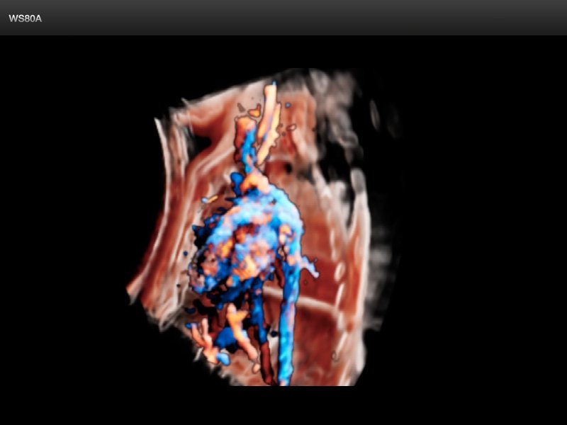 Fetal liver blood flow, Crystal Vue Flow, 3D  (echogramm №845)