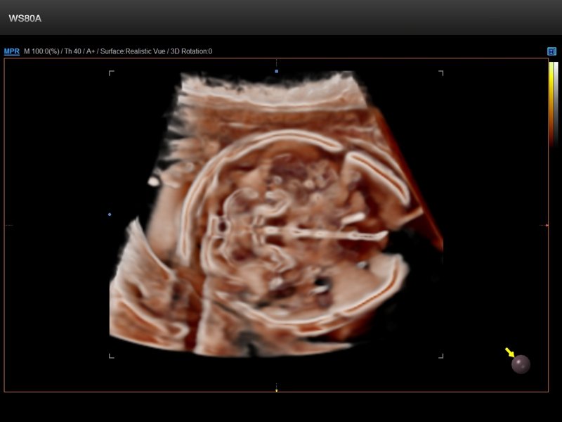 Fetal brain, Crystal Vue, 3D (echogramm №846)