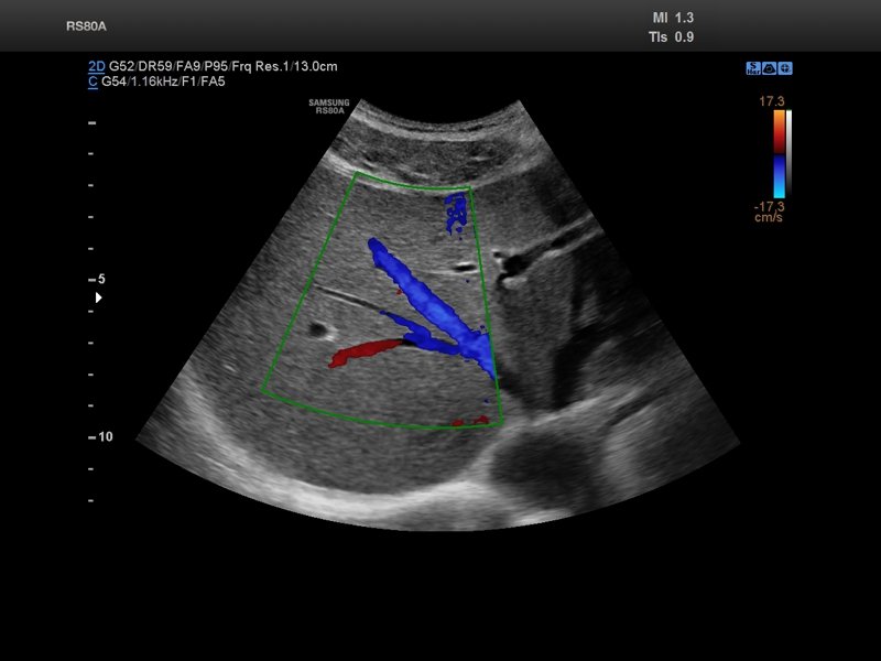 Liver, Color Doppler (echogramm №848)