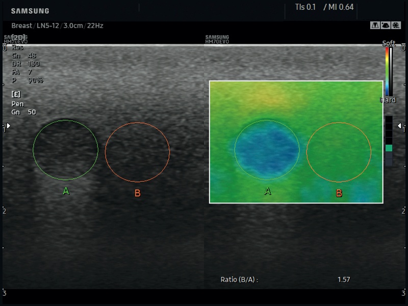 Breast, E-Strain (echogramm №850)