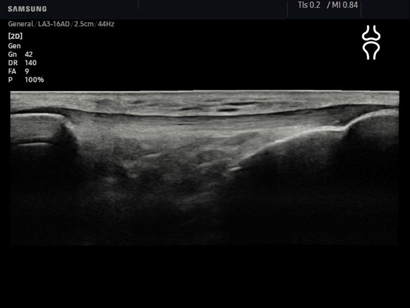 Patellar tendon, Panoramic (echogramm №851)