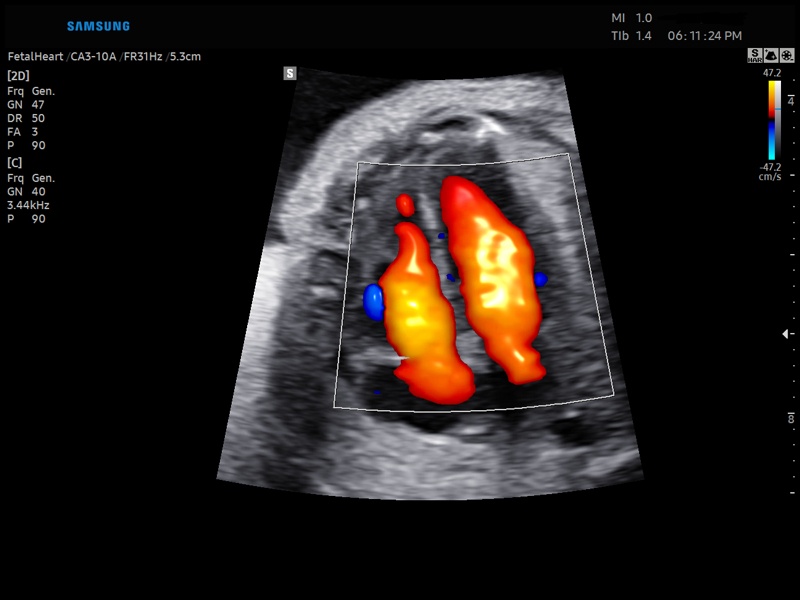 Fetal heart (4 chamber view), LumiFlow (echogramm №854)