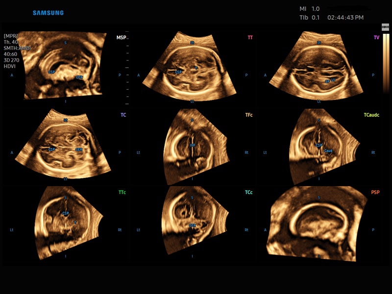 Fetal brain, 5D CNS+ (echogramm №855)