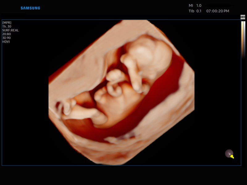 Fetus - early gestation, Realistic Vue, 3D (echogramm №857)
