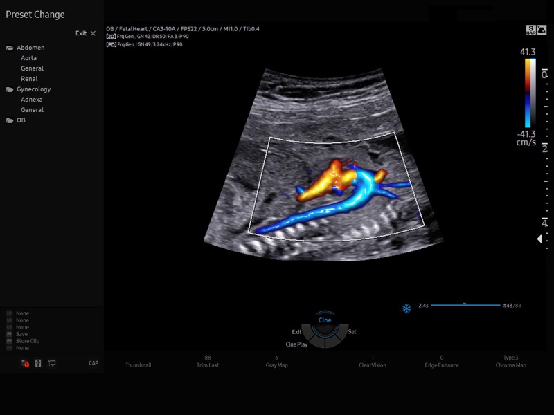 Fetal aorta, LumiFlow (echogramm №859)