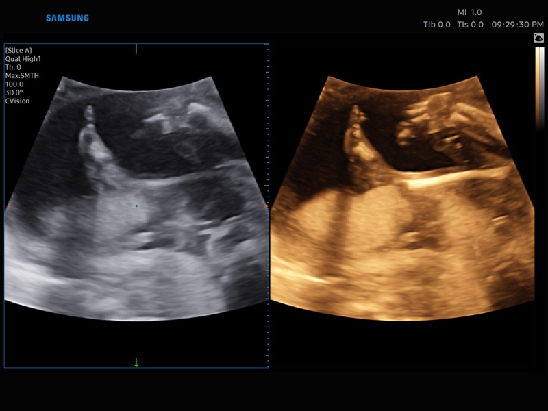 Fetal drumstick, Slice A (echogramm №860)