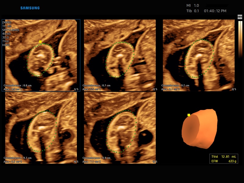 Fetus, 5D Limb Vol (echogramm №862)