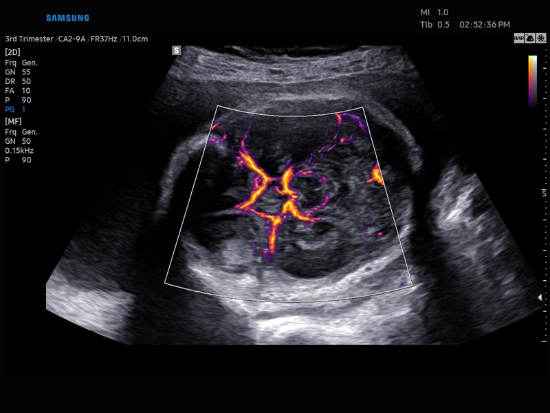 Circle of Willis, MV-Flow + LumiFlow (echogramm №864)