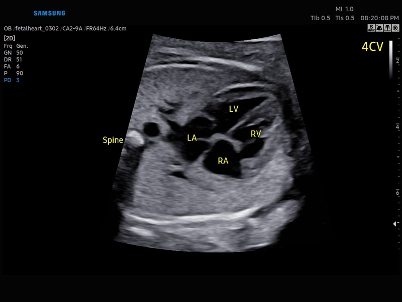 Fetal heart, ViewAssist (echogramm №866)
