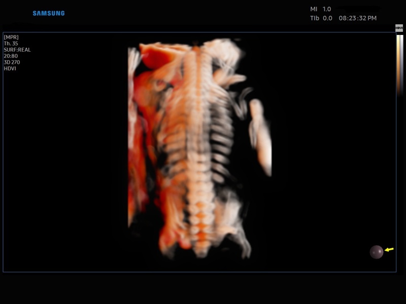 Fetal spine, CrystalVue, 3D (echogramm №868)