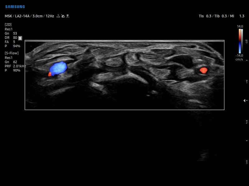 Finger flexor tendons, MV-Flow (echogramm №870)