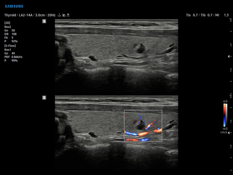 Thyroid - nodule, S-Flow (echogramm №871)