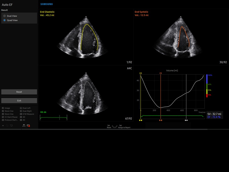 Heart, Auto EF (echogramm №874)