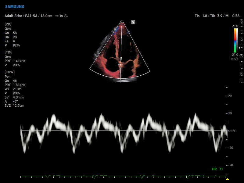 Heart, tissue doppler (echogramm №875)